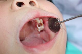 0-6歲兒童口腔清潔全攻略 科學(xué)選擇用品與養(yǎng)成衛(wèi)生習(xí)慣