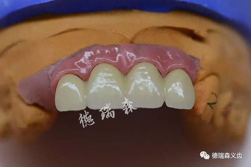 種植牙與口腔衛(wèi)生用品 長(zhǎng)期使用的關(guān)鍵